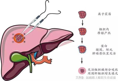 放疗治肝癌效果